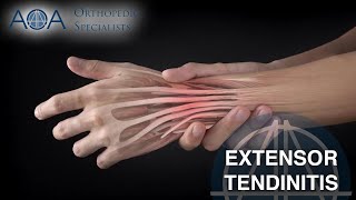 AOA Orthopedic Specialists  Extensor Tendinitis [upl. by Pierrette356]