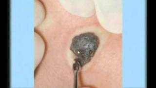 Seborrheic Keratosis Treatment [upl. by Ybanrab]