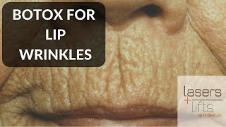 BOTOX for lip wrinkles [upl. by Oisinoid571]