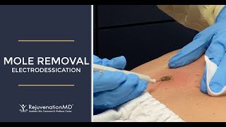 Electrodessication to Remove Seborrheic Keratosis [upl. by Remo]