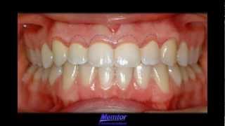 GingivoplastyGingivectomy [upl. by Anaela]