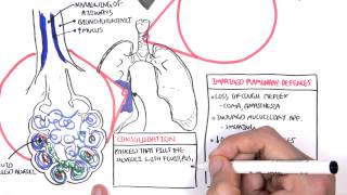 PART I  Pneumonia Overview Lobar and Bronchopneumonia [upl. by Glaudia702]