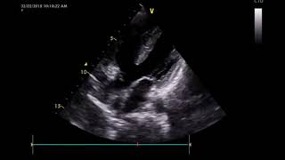 Tetralogy of Fallot TOF [upl. by Oratnek]