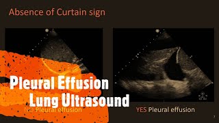 Pleural Effusion Lung Ultrasound Perioperative amp Critical Care POCUS [upl. by Novyat]