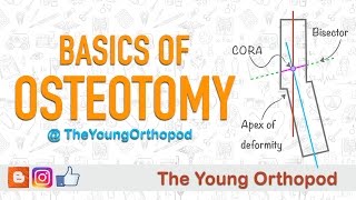 High Tibial Osteotomy  Dr Douglas Wyland [upl. by Dijam]