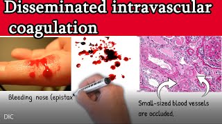 Disseminated intravascular coagulation DIC  Causes Symptoms Treatment and prognosis [upl. by Lyrahc]