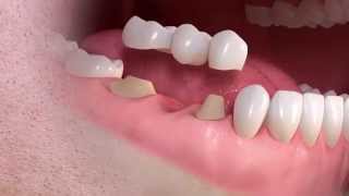 Straumann  Conventional 3unit bridge treatment [upl. by Rebma405]