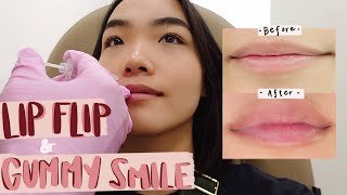 getting my lips done  lip flip  gummy smile transformation [upl. by Lyns95]