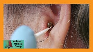 Chunky Earwax Removal  Auburn Medical Group [upl. by Airdua539]