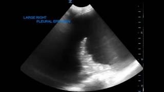 Pleural Effusion on Ultrasound JETem 2016 [upl. by Ezarra697]