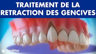 Récession Gingivale – Traitement de la retraction des gencives © [upl. by Salhcin]