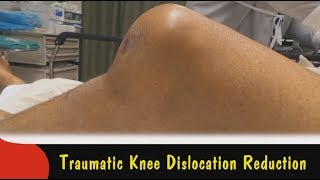 Traumatic Knee Dislocation Reduction [upl. by Janiuszck]