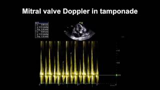 Echocardiography Essentials Detecting pericardial effusions [upl. by Carder]