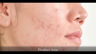 Acne 101 What Is The Cause Of My Breakouts [upl. by Eittik]