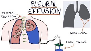 Understanding Pleural Effusions [upl. by Dwane879]