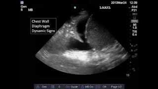 Lung and Pleural Ultrasound Interpretation [upl. by Dore306]