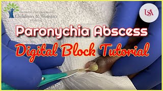 Finger Paronychia Emergency amp Digital Block Tutorial [upl. by Adnohryt]