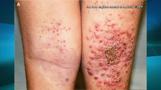 What You Need to Know if You Have Eczema [upl. by Ynnavoj]