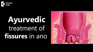 Closure of Fistula Tract with Laser [upl. by Analle279]