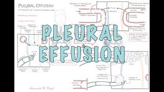 Pleural Effusion DETAILED  pathophysiology signs and symptoms treatment [upl. by Uwton]