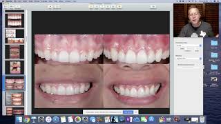 Gingivectomy vs Crown Lengthening Education for dental staff [upl. by Antonin872]