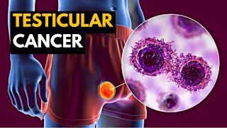 How to Prevent Testicular Cancer  Testicular Cancer [upl. by Ruggiero]