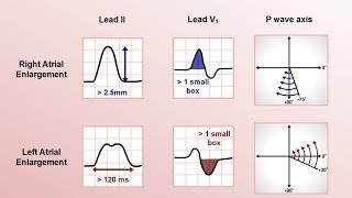 Intro to EKG Interpretation  Chamber Enlargement [upl. by Storfer]