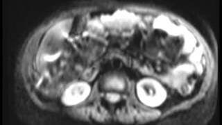 Peritoneal Carcinomatosis [upl. by Coffeng]