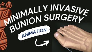 Minimally Invasive Bunion Surgery A Short Animation [upl. by Ardnuek]