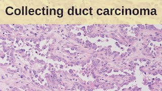 Collecting Duct Carcinoma  Pathology mini tutorial [upl. by Sisile]