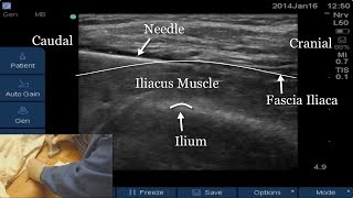 USGuided Fascia Iliaca Block FULL VIDEO LINK BELOW [upl. by Horter]