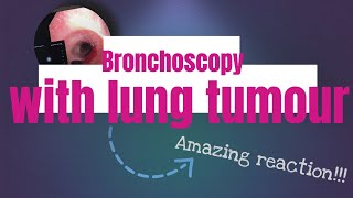 Lung Cancer Diagnosis  Navigational Bronchoscopy – Dr Neeraj Desai Northwest Community Healthcare [upl. by Mraz]