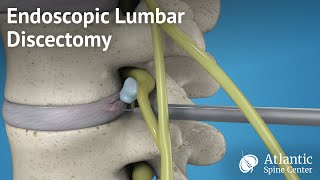 Endoscopic Lumbar Discectomy [upl. by Erhart]