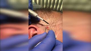 Seborrhoeic Keratosis Removal Demo [upl. by Imoan348]