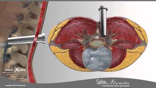 Lumbar Microdiscectomy  Spine Center Northern Nevada Northern California  Spine Surgery [upl. by Pippas]