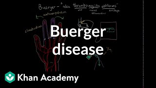 Buerger disease  Circulatory System and Disease  NCLEXRN  Khan Academy [upl. by Ahsilaf]