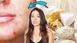 Nutritionists Reveal Which Foods Affect Your Acne [upl. by Nyllaf219]