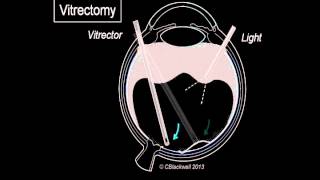 Vitreous 3 Vitrectomy Surgery [upl. by Ecirbaf]