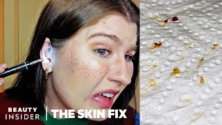 Earwax Cleaner Has Builtin Microscope  The Skin Fix [upl. by Keiryt]