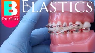 BRACES EXPLAINED Elastics  Rubber Bands [upl. by Seraphina]