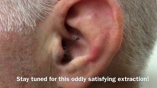 Ear Blackhead Extraction  Dr Steven Greene in Seattle [upl. by Eivla953]