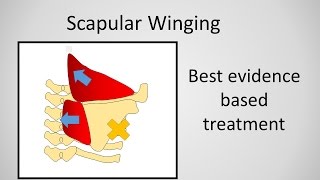 Scapular Winging Causes and Treatment [upl. by Jaclyn533]