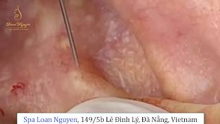 REMOVAL GOLD ACNE ON THE EAR 191  Loan Nguyen [upl. by Wagoner]