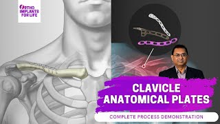 Clavicle Anatomical Plates Fixation Procedure [upl. by Arrak]