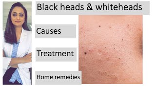 How to remove blackheads amp whiteheads Causes Treatment  Home remedies dermatologist [upl. by Elleoj]