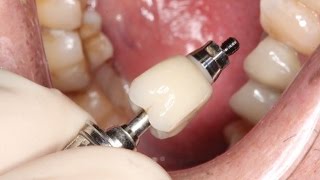 Full Contour Zirconia Implant Crown Insert [upl. by Engedi506]