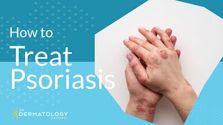 Psoriasis Treatment  Explained by Dermatologist [upl. by Evered]