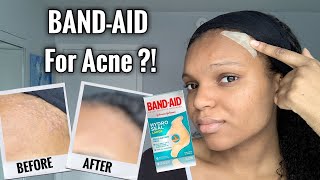 BANDAID FOR ACNE  I Tested Hydrocolloid Bandages for 1 Week  Hydro Seal BandAid for Acne [upl. by Wynn841]