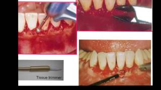 Gingivectomy amp Gingivoplasty [upl. by Turner]