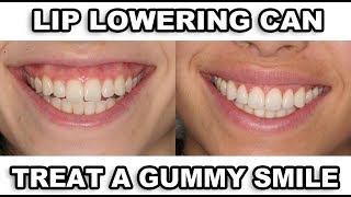 Gummy Smile Correction REAL RESULTS [upl. by Eirrac]